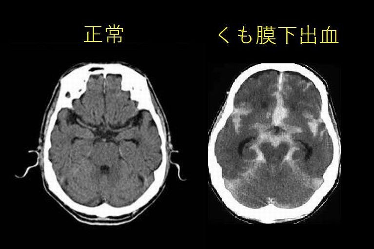 くも膜下出血