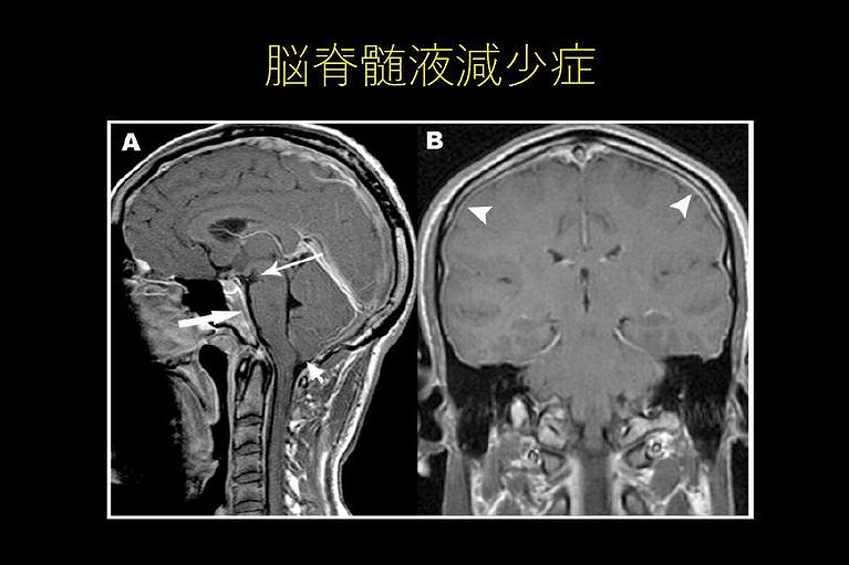 脳脊髄液減少症