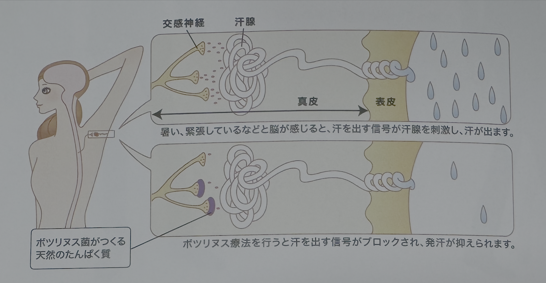 多汗症ボトックス注射